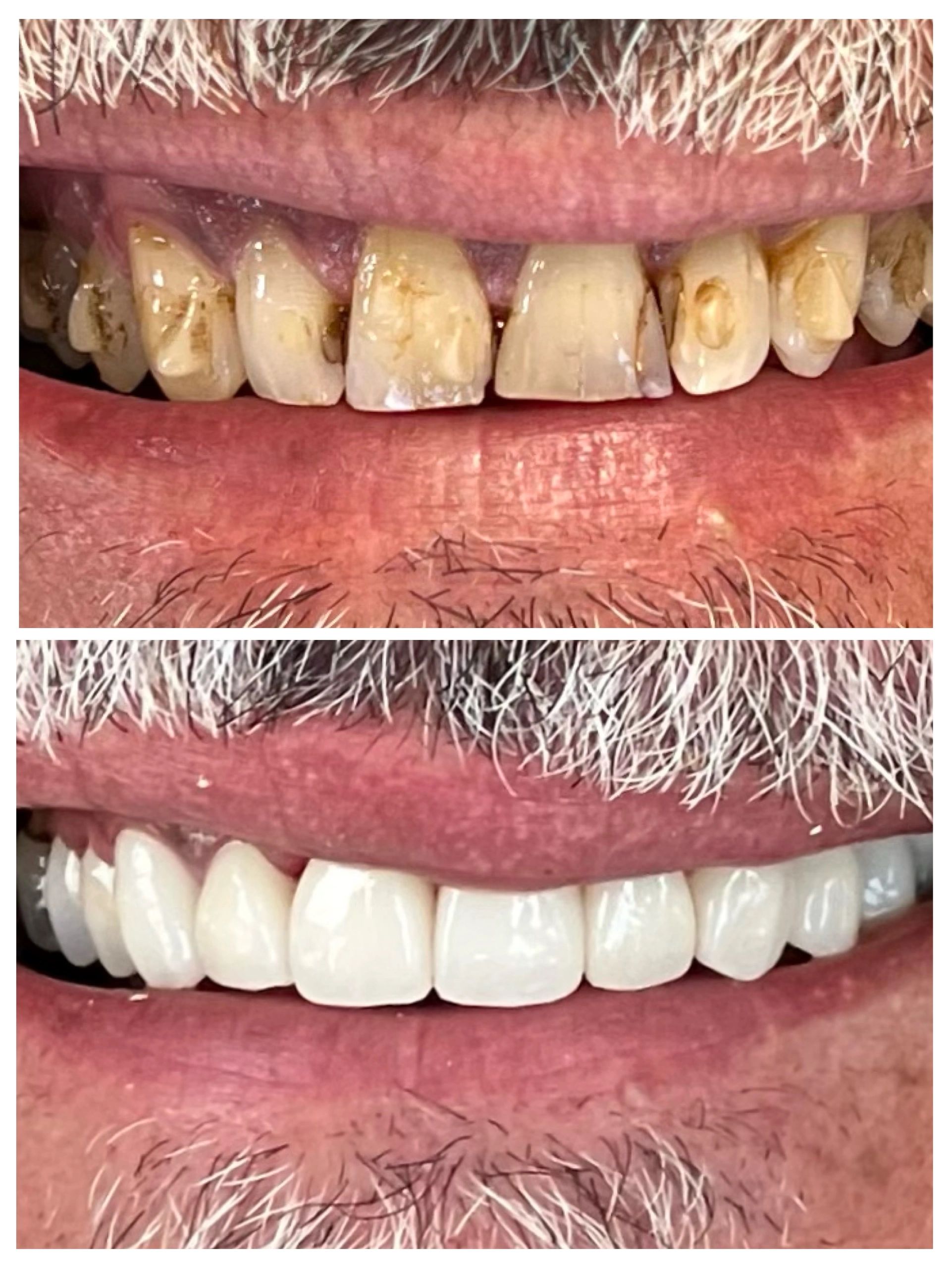 Enhancing Smiles Dental Crowns at Diamond Dental of Beachwood